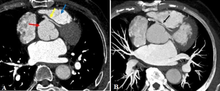 This diagnostic image consists of two Computed Tomography (CT) coronary angiogram reconstructions (A and B) demonstrating an anomalous origin and course of the left main coronary artery (LMCA). Image A is an axial reconstruction showing the LMCA (yellow arrow) taking a high-risk interarterial course between the ascending aorta (red arrow) and the pulmonary outflow tract (blue arrow). Image B utilizes Maximum Intensity Projection (MIP) reconstruction to highlight a clinically significant narrowing of the anomalous LMCA (black arrow) as it traverses between the great vessels, exhibiting an intramural or 'slit-like' appearance characteristic of malignant coronary artery anomalies. This case illustrates the diagnostic role of CT angiography in identifying congenital coronary variants and assessing for potential vascular compression. The findings are relevant for cardiology and radiology specialties, focusing on the pathophysiology of sudden cardiac death or myocardial ischemia related to anomalous coronary anatomy.