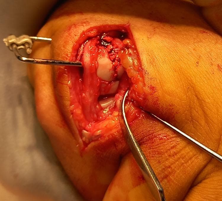 This clinical intraoperative photograph displays an open reduction and internal fixation (ORIF) procedure of a comminuted intra-articular fracture of the fifth metacarpal head in a human hand. The surgical field reveals an elliptical incision with retracted skin and subcutaneous adipose tissue, exposing the dorsal aspect of the metacarpophalangeal joint. Centrally, the articular surface of the metacarpal head is visible, showing significant impaction, depression, and bony comminution with associated hemorrhage. A metallic pointed reduction clamp is being used to manipulate and stabilize bone fragments. To the left, a K-wire is seen traversing the soft tissue and bone, connected externally to a component of an HK dynamic external fixator system. The image illustrates complex orthopedic management of hand trauma, specifically targeting the restoration of articular congruity in a joint-involved fracture where standard screw fixation may be insufficient due to bone stock loss. This material is suited for orthopedic surgical education regarding fracture stabilization and the application of external fixation devices.