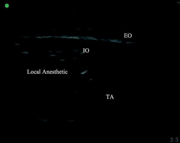 This diagnostic ultrasound image demonstrates a Transversus Abdominis Plane (TAP) block, a regional anesthesia technique. The image displays the distinct anatomical layers of the anterolateral abdominal wall. Labeled structures include the External Oblique (EO) as the most superficial muscle layer, followed by the Internal Oblique (IO) muscle. The deepest visualized layer is the Transversus Abdominis (TA) muscle. The muscle layers appear as relatively hyperechoic bands with a striated texture. A prominent hypoechoic (dark) fluid collection is visible between the IO and TA muscles, representing the correctly placed local anesthetic within the transversus abdominis plane. This clinical image is used to teach ultrasound-guided needle placement and the recognition of fascial planes for postoperative analgesia in abdominal surgery, such as laparoscopic rectal cancer resection. The visualization confirms the target plane for drug deposition to achieve sensory blockade of the anterior abdominal wall nerves.