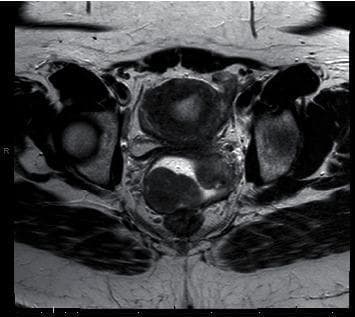 This diagnostic image is an axial T2-weighted MRI of the female pelvis, demonstrating a prominent mass in the superior vaginal fornix. The image shows a clear anatomical distinction between the cervix and the pathological lesion. On the patient's left side, the cervix is visible as a rounded structure with heterogeneous signal intensity. On the patient's right side, there is a large, somewhat circumscribed vaginal mass exhibiting complex internal characteristics. The mass displays central high signal intensity, suggestive of necrosis or fluid content, surrounded by a lower-signal-intensity rim. While the borders are relatively well-defined, there is evidence of displacement of adjacent pelvic structures and blurring of the anterior margin, raising the possibility of focal extension. The surrounding pelvic anatomy, including the musculature and hip joints, is visible as landmarks. This image is clinically significant for the assessment of gynecological smooth muscle tumors, such as leiomyosarcoma or cellular leiomyoma, and aids in surgical planning by mapping the mass relative to the cervix and vaginal walls.
