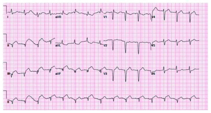 This diagnostic image is a 12-lead electrocardiogram (ECG) demonstrating acute ST-segment elevation myocardial infarction (STEMI) patterns. The primary visual abnormality is significant ST-segment elevation (approximately 2.5–3 mm) in the inferior leads (II, III, and aVF). The morphology of the ST segments is convex ('tombstoning') and transitions into upright, prominent T waves. Reciprocal ST-segment depression is visible in the lateral lead aVL. The rhythm is regular and appears to be a normal sinus rhythm with identifiable P waves preceding each narrow QRS complex. There are also deep Q waves present in the inferior leads, suggesting an established or previous inferior wall injury. Precordial leads (V1-V6) show relatively deep S waves and some T-wave flattening, consistent with left ventricular hypertrophy or secondary changes. This tracing is clinically significant for diagnosing an acute inferior STEMI, often associated with right coronary artery (RCA) or left circumflex (LCx) occlusion. It serves as a key educational example for interpreting acute ischemic changes and reciprocal findings on a standard 12-lead ECG.