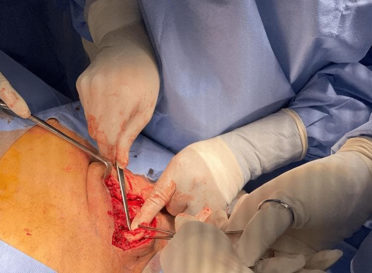 This clinical photograph shows an intraoperative view of a surgical procedure involving the right sternoclavicular joint (SCJ). The image captures an open anterior clavicle approach with exposed deep tissue and bone. Two Kocher forceps are utilized to mark and grasp the medial clavicle in preparation for resection. Additional surgical instruments, including a metal retractor and a scalpel handle, are visible within the operative field, which exhibits significant hemorrhagic staining and disrupted soft tissue consistent with active debridement for septic arthritis. The surgical team is seen wearing sterile blue gowns and light-colored surgical gloves with visible blood staining. This visual serves as an educational example of orthopedic surgical management for SCJ infection, specifically demonstrating the marking of the resection length on the medial clavicle. The image illustrates the anatomical relationship of the medial clavicle to the surrounding anterior chest wall musculature and the depth of the surgical field required for effective joint irrigation and debridement.
