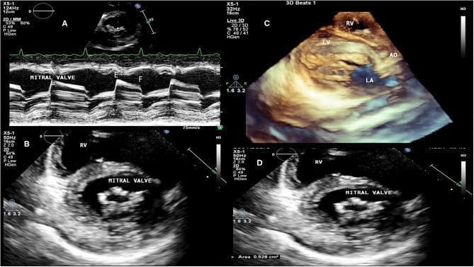 A multi-panel echocardiographic series demonstrating chronic rheumatic heart disease with severe mitral valve stenosis. Panel A shows an M-mode transthoracic echocardiogram of the mitral valve, highlighting a classic rectification (flattening) of the E to F slope, indicating a slow diastolic filling rate. Panel B and D provide 2D transthoracic views in the short-axis/transversal plane, revealing significant thickening and calcification of the mitral leaflets and a restricted, 'buttonhole' or 'fish-mouth' shaped orifice; panel D includes planimetry measuring a critical mitral valve area of 0.528 cm². Panel C utilizes 3D transthoracic echocardiography to visualize the complex subvalvular apparatus, showing chordae fusion and anatomical relationships between the right ventricle (RV), left ventricle (LV), aorta (AO), and left atrium (LA). The collection illustrates diagnostic hallmarks of rheumatic valvular aggression, including commissural fusion and restricted diastolic opening, used for clinical staging and procedural planning.