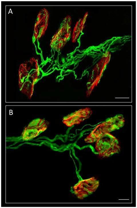 This dual-panel diagnostic image displays confocal immunofluorescence of mouse neuromuscular junctions (NMJs) in the Levator auris longus muscle. Panels A and B demonstrate different innervation states: polyinnervation (A) and monoinnervation (B). The presynaptic axons are stained green using a 200-kD neurofilament antibody, revealing thread-like structures and branching patterns. The postsynaptic nicotinic acetylcholine receptors (nAChR) are labeled red with TRITC-α-bungarotoxin (TRITC-α-BTX), appearing as compact or elongated clusters. Panel A illustrates high-density axonal branching typical of early development, where multiple axons innervate single motor endplates. Panel B showcases a more refined organization with fewer axonal branches per motor unit, representing the results of Hebbian competition and synapse elimination. Areas of signal overlap appear yellow/merged, indicating direct contact between axons and receptor clusters. This image is used to study neurodevelopmental processes, synapse maturation, and the role of signaling pathways (like PKA/PKC) in axonal loss. Scale bar: 10 μm.