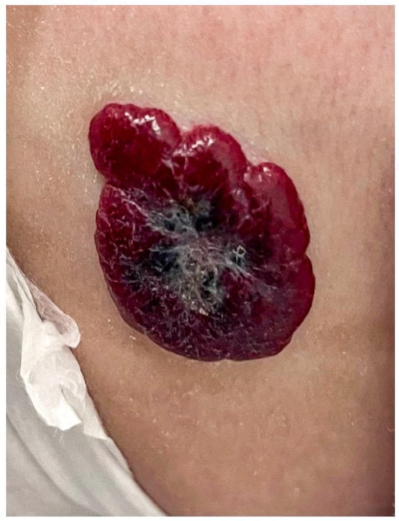 This clinical photograph displays a superficial, plaque-like skin lesion on the fair-toned skin of an infant, characteristic of an infantile hemangioma. The lesion is primarily a vibrant 'strawberry-red' color with a well-circumscribed but irregular, oval border. Its texture is notably lobulated and nodular, with a raised profile above the surrounding skin surface. The central portion of the lesion exhibits areas of deeper bluish-purple discoloration interspersed with fine grayish-white patches, which may indicate early regression or variations in vascular density. The surrounding skin appears healthy with normal texture, and small water droplets are visible nearby. This image serves as a classic pediatric dermatology example of a common benign vascular tumor during its growth phase, illustrating the typical morphology, color, and lobular architecture used for clinical diagnosis and monitoring of infantile hemangiomas.