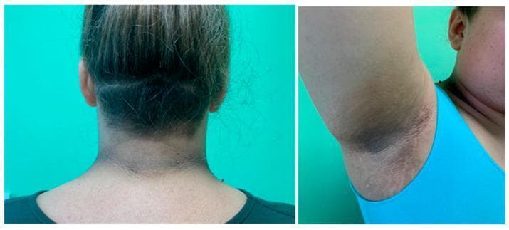 Clinical photograph showing classic dermatological manifestations of Acanthosis nigricans in two key anatomical locations: the posterior neck and the axilla (armpit). The left panel displays the back of the neck, revealing a broad, horizontal band of symmetric, grey-brown hyperpigmentation. The skin exhibits characteristic 'velvety' thickening (hyperkeratosis) and accentuated skin lines. The right panel shows a similar presentation in the axillary vault, where the hyperpigmentation is more pronounced and well-demarcated against the surrounding normal skin, following the folds of the intertriginous area. These visible changes are significant clinical markers often associated with systemic conditions such as insulin resistance, obesity, and metabolic syndrome. The image serves as an educational tool for identifying the typical morphology and distribution of this cutaneous sign, emphasizing the importance of recognizing texture and color changes in intertriginous zones for diagnostic assessment.
