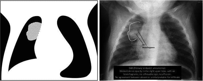This educational composite contains a pediatric chest radiograph and a corresponding simplified anatomical diagram illustrating the WHO criteria for primary endpoint pneumonia. The right-sided image is an anteroposterior (AP) diagnostic X-ray of a child's chest. It demonstrates a focal, bilobed dense opacity in the right upper lobe, highlighted by a white outline. Significant radiographic features within this consolidated region include air bronchograms—linear lucencies representing air-filled bronchi against fluid-filled alveoli. There is no evidence of a silhouette sign at the heart border, and no pleural effusion is visible. The left-sided image is a high-contrast schematic diagram serving as a teaching tool; it uses a diagonal hatched pattern to map the exact anatomical location and morphology of the consolidation described in the radiograph. This material is designed for epidemiological training to standardize the identification of radiologically confirmed pneumonia, focusing on dense consolidation and distinguishing features like air bronchograms and the presence or absence of pleural fluid.