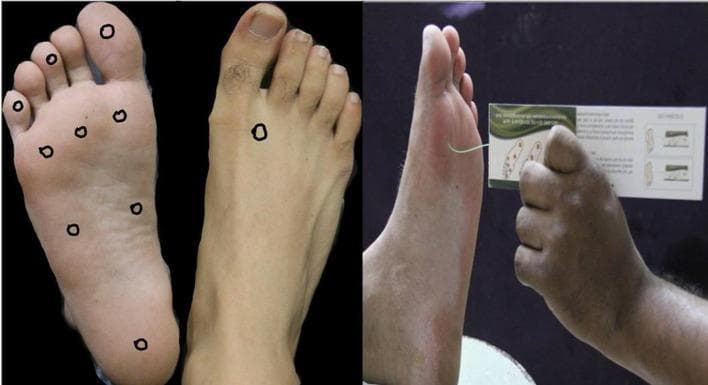 This composite educational image illustrates the Semmes-Weinstein 10 g monofilament test, a standard clinical procedure for assessing loss of protective sensation (LOPS) in patients with diabetes mellitus. The left panel demonstrates the specific testing sites marked with circles: nine sites on the plantar surface—including the distal great, third, and fifth toes; the first, third, and fifth metatarsal heads; the medial and lateral midfoot; and the heel—and one site on the dorsal surface between the first and second metatarsals. The right panel displays the clinical application of the test. A clinician’s hand is shown holding the monofilament perpendicularly to the skin of the foot's dorsal surface. The monofilament is bent into a C-shape, indicating the correct application of a 10 g buckling force. This visual serves as a procedural guide for medical professionals to screen for peripheral neuropathy and identify patients at risk for diabetic foot ulceration and secondary complications like gangrene.
