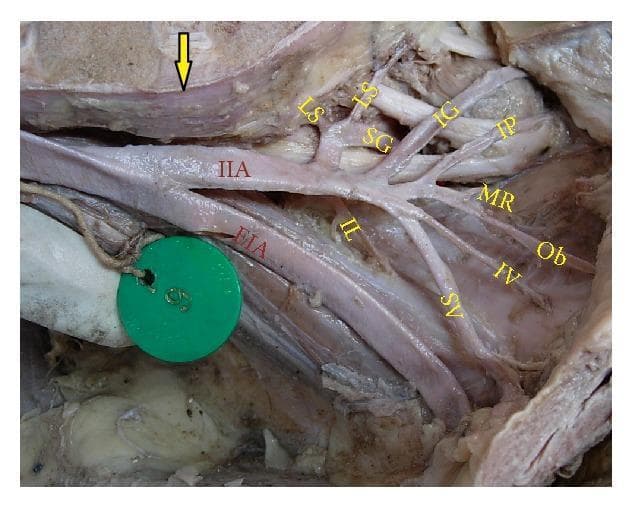 This clinical photograph displays a cadaveric dissection of the right human pelvic wall, focusing on the arterial anatomy. The image demonstrates the bifurcation of the common iliac artery at the level of the lumbosacral joint (indicated by a yellow arrow). The external iliac artery (EIA) is seen continuing toward the lower limb, while the internal iliac artery (IIA) branches extensively to supply pelvic viscera and muscles. Key vascular branches are labeled with yellow text: the superior gluteal (SG), inferior gluteal (IG), and internal pudendal (IP) arteries; the superior vesical (SV), inferior vesical (IV), and middle rectal (MR) arteries; and the obturator (Ob), lateral sacral (LS), and iliolumbar (IL) arteries. This visual serves as an educational anatomical reference for surgical training and radiological correlation, illustrating the complex branching patterns and spatial relationships of the internal iliac arterial system within the pelvic cavity.