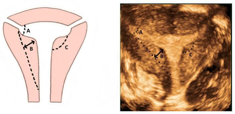 This composite image includes a diagram and a corresponding 3D ultrasound image illustrating the diagnostic criteria for a T-shaped uterus, a type of Mullerian duct anomaly (Class U1). The visualization focuses on the Congenital Uterine Malformation Experts (CUME) criteria in the coronal plane. Both images are annotated with three key measurable parameters: 'A' denotes the T-angle (typically ≤ 40°), formed by the intersection of the lateral borders of the uterine cavity; 'B' indicates the lateral indentation depth (typically ≥ 7 mm), measuring the thickness and inward protrusion of the lateral myometrial walls; and 'C' represents the lateral indentation angle (typically ≤ 130°). The 3D ultrasound demonstrates a constricted, narrow endometrial cavity with thickened lateral walls and a characteristic T-like morphology, contrasting with the normal triangular uterine cavity. This content is intended for medical education in gynecology, reproductive endocrinology, and radiology to improve the objective classification of dysmorphic uteri.