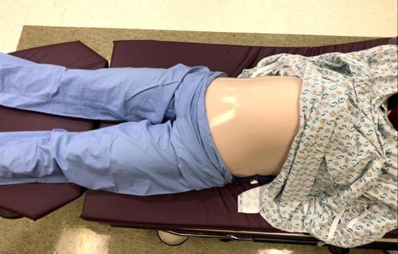 A clinical procedural image showing a low-fidelity medical simulation model of a pregnant patient in a supine position on a dark purple examination bed. The model is used for training in obstetrical maneuvers, specifically External Cephalic Version (ECV). The visual setup includes a lower body covered in light blue surgical scrubs and an upper torso draped in a patterned hospital gown. The central focus is a simulated gravid abdomen, constructed from skin-toned silicone layered over a pillowcase base. This abdominal component creates a smooth, rounded protuberance that replicates the anatomical appearance of a late-term pregnancy. The model is designed to house an internal 'uterus' mechanism—typically consisting of nested balloons and a fetal mannequin—to allow residents to practice palpation and the manual rotation of a fetus from a breech to a cephalic presentation. The image demonstrates the clinical application of simulation-based medical education (SBME) for improving procedural comfort and competency in obstetric care.