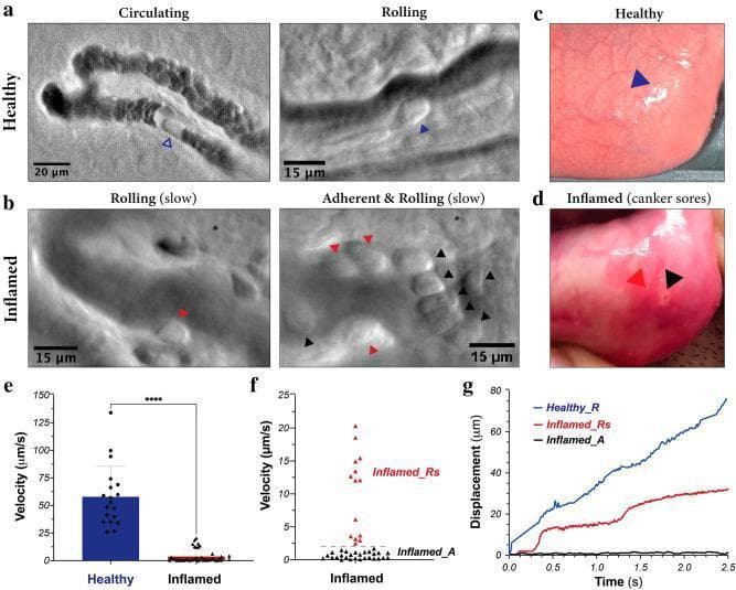 Educational panel illustrating in vivo leukocyte dynamics within human oral mucosa microvasculature under healthy and inflamed conditions, captured using oblique back-illumination microscopy (mOBM). Panels (a) and (c) depict healthy tissue with uniform mucosal appearance and leukocytes exhibiting normal circulation and rolling behavior (blue arrowheads). Panels (b) and (d) show inflamed tissue featuring a canker sore, characterized macroscopically by focal erythema and microscopically by slow-rolling (red arrowheads) and stationary, adherent leukocytes (black arrowheads) forming clusters along the endothelium. Quantitative analysis is provided in graphs (e-g): Panel (e) shows a significant reduction in mean leukocyte velocity in inflamed tissue (p < 0.0001); panel (f) distinguishes two subpopulations in inflammation—slow-rolling (Inflamed_Rs) and adherent (Inflamed_A); panel (g) tracks displacement over time, contrasting the continuous movement in healthy vessels against the 'stop-and-go' or near-zero displacement patterns in inflamed vessels. This content demonstrates the pathophysiological recruitment of leukocytes (tethering, rolling, and adhesion) during a localized inflammatory response.