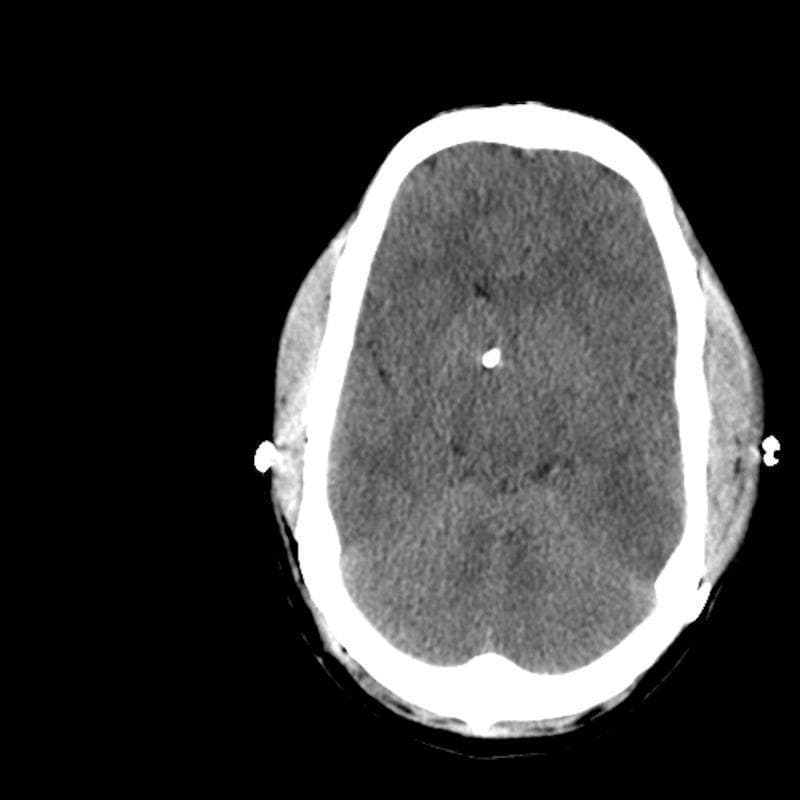 This diagnostic image is an axial non-contrast Computed Tomography (CT) scan of the brain, demonstrating features consistent with slit ventricle syndrome. The hallmark finding is the presence of extremely small, 'slit-like' lateral ventricles, indicating a significant reduction in cerebrospinal fluid (CSF) volume within the ventricular system. The brain parenchyma appears tightly compacted against the inner table of the skull, with a notable effacement of the cortical sulci and basal cisterns, suggesting increased intracranial pressure or a disproportionate brain-to-cranial vault ratio. A hyperdense punctate focus is visible near the midline, consistent with the distal tip of a ventricular catheter or shunt hardware. The surrounding skull shows intact bone structure, though the overall cranial volume appears relatively small for the parenchymal mass. This imaging is clinically significant for evaluating patients with chronic shunt dependence who present with intracranial hypertension despite appearing to have collapsed or 'normal' small ventricles on imaging.