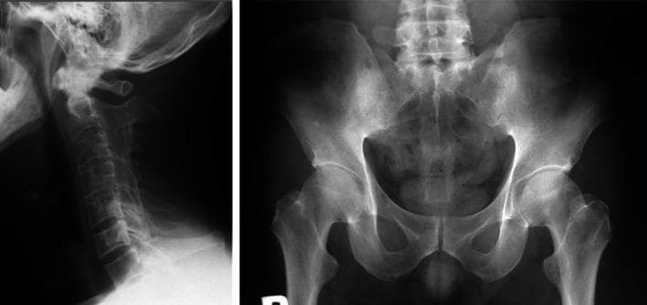 This composite diagnostic image features two X-ray radiographs illustrating the hallmark skeletal manifestations of advanced ankylosing spondylitis (SpA). The left panel is a lateral radiograph of the cervical spine showing 'bamboo spine' morphology. It demonstrates extensive marginal syndesmophytes and ankylosis leading to the fusion of vertebral bodies and complete ossification of the intervertebral disc spaces. The result is a continuous, rigid vertebral column with loss of the normal cervical lordosis. The right panel is an anteroposterior (AP) radiograph of the pelvis focusing on the sacroiliac (SI) joints. Both SI joints show Grade 4 sacroiliitis according to the Modified New York criteria, characterized by total ankylosis (fusion), significant subchondral sclerosis, and loss of visible joint space. These findings represent end-stage chronic inflammation in axial spondyloarthritis. The image is intended for medical education regarding the progression of rheumatological conditions and the interpretation of radiological signs of spinal fusion and sacroiliitis.