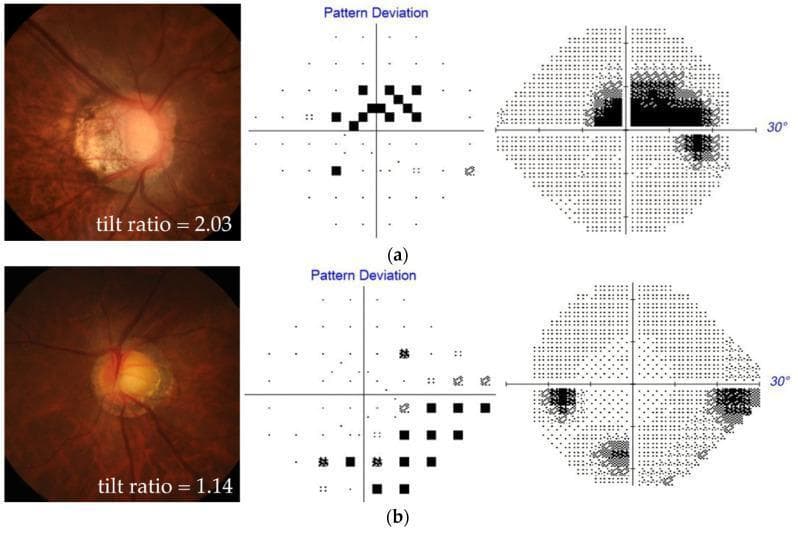 A comparison of optic disc morphology and visual field defects in two patients with myopia and open-angle glaucoma (OAG). The image is organized into two rows, (a) and (b), each featuring three components: stereo disc photography, a Humphrey perimetry pattern deviation plot, and a grayscale visual field map. Patient (a) displays high optic disc tilt (tilt ratio 2.03) with significant elongation and a shifted central retinal vessel trunk. This correlates with a paracentral scotoma, visible as a cluster of significant defects within the central 10 degrees on the pattern deviation plot and a dense superior/central defect on the grayscale map. Patient (b) shows a less tilted, more circular optic disc (tilt ratio 1.14) associated with peripheral scotoma. The perimetry for patient (b) illustrates defects primarily in the inferior and superior peripheral regions, with relative sparing of the central field. This comparison illustrates the relationship between myopic optic disc deformation (tilt) and the localization of glaucomatous visual field loss, highlighting the difference between paracentral and peripheral scotoma patterns in highly myopic eyes.