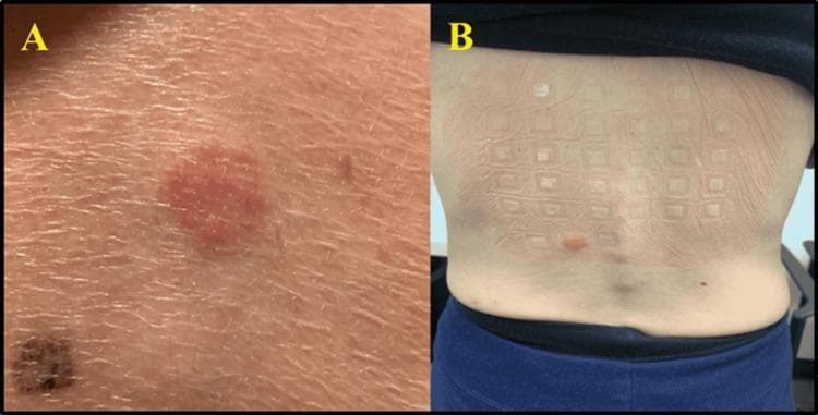 This composite clinical photograph displays the results of dermatological patch testing for Type IV delayed hypersensitivity reactions. Image A is a close-up of a positive nickel patch test, showing a well-demarcated, erythematous, and slightly edematous circular plaque on the skin, characteristic of allergic contact dermatitis. Image B provides a posterior view of a patient's back, illustrating a comprehensive patch test series arranged in a standardized grid-like pattern. Most test sites show only faint rectangular impressions from the adhesive chambers; however, a prominent positive reaction is visible in the lower left quadrant of the grid, appearing as a localized, raised erythematous patch. These images demonstrate the clinical manifestation of cell-mediated immune responses to specific allergens, such as gold and nickel, which are used to diagnose systemic or contact-related allergic reactions in patients presenting with drug exanthems or nonspecific urticaria.