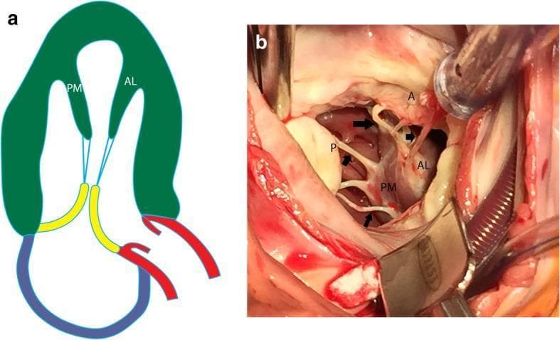 This dual-panel educational material illustrates the normal anatomy of the mitral valve apparatus within the left ventricle. Panel A is an anatomical diagram in a vertical long-axis projection showing the anterolateral (AL) and posteromedial (PM) papillary muscles (green) originating from the ventricular wall. Blue lines represent chordae tendineae connecting the papillary muscles to the mitral valve leaflets (yellow). Panel B is an intraoperative clinical photograph providing a direct surgical view of these structures. It clearly demonstrates the fleshy heads of the anterolateral (AL) and posteromedial (PM) papillary muscles. Multiple thin, white fibrous strands—the chordae tendineae (indicated by black arrows)—extend from the papillary muscle heads to insert into the anterior (A) and posterior (P) mitral valve leaflets. The image highlights the mechanical tethering system essential for valvular competence during the cardiac cycle, specifically demonstrating how both papillary muscles contribute chordae to both leaflets to prevent valve prolapse into the left atrium during systole.