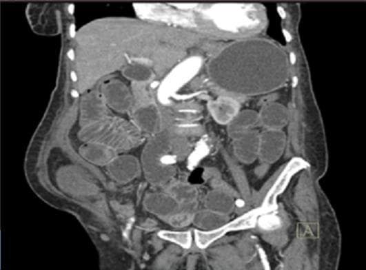 Coronal reconstruction of a contrast-enhanced abdominal computerized tomography (CT) scan. The image demonstrates a Spigelian hernia, characterized by a defect in the abdominal wall along the semilunar line. An interparietal hernia sac is visible, containing an incarcerated small bowel loop. Notably, the wall of the herniated intestinal loop shows a lack of contrast enhancement compared to surrounding loops, a diagnostic sign indicative of ischemia or necrosis. Proximal to the site of obstruction, multiple small bowel loops are markedly distended with fluid, while the distal colon appears collapsed or 'flat,' confirming a high-grade mechanical bowel obstruction. Major abdominal vascular structures are well-opacified by intravenous contrast. No significant free air or intraperitoneal effusion is visualized. This diagnostic image illustrates the radiological features of a strangulated Spigelian hernia with associated intestinal ischemia and proximal bowel obstruction.