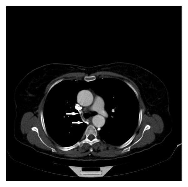 This axial thoracic CT angiography image demonstrates the anatomy of the mediastinum at the level of the aortic arch. The primary focus is the right azygos vein, marked with white arrows, as it arches anteriorly to discharge into the posterior aspect of the superior vena cava (SVC). The SVC appears slightly compressed or displaced, which context suggests is due to an aneurysmal dilatation of the adjacent ascending aorta. Other visible anatomical structures include the large diameter of the ascending aorta, the descending aorta situated posteriorly to the left, the trachea at the midline, and the esophagus. The pulmonary trunk and portions of the lungs are also visible. The image highlights the drainage pathway of the azygos system and illustrates how adjacent vascular pathologies, such as an aortic aneurysm, can exert mass effect on the low-pressure venous structures of the mediastinum. This content is valuable for students and radiologists studying thoracic vascular anatomy and the clinical presentation of aortic aneurysms.