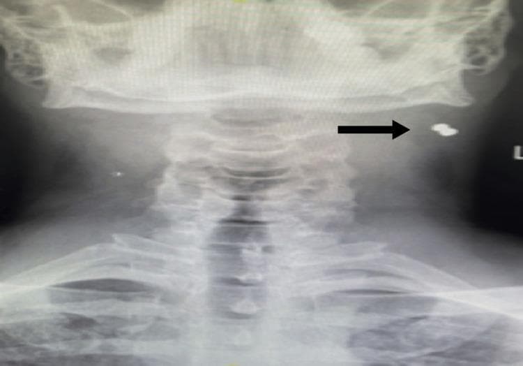 This diagnostic image is an anterior-posterior (AP) X-ray of the neck and upper cervical region. The radiograph reveals the cervical vertebrae, mandible, and clavicles. A highly radiopaque metallic foreign body (MFB) is visible on the left side of the neck, indicated by a black horizontal arrow. The foreign body is located in the soft tissues lateral to the mid-cervical spine and inferior to the angle of the left mandible, corresponding to the anatomical region of the sternocleidomastoid muscle (Level IIA). The object displays a distinct high-density signature typical of metal, suggesting a projectile or trauma-related origin. This imaging serves to demonstrate the localization of non-biological materials within the neck's soft tissue compartments relative to critical skeletal landmarks.