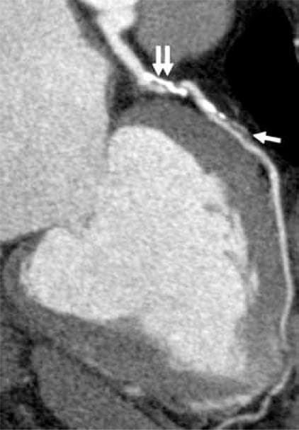 This diagnostic image is a 2D curved planar reformatted (CPR) view of a coronary computed tomography angiography (CCTA) obtained via multi-detector computed tomography (MDCT). It depicts the Left Anterior Descending (LAD) coronary artery traversing the epicardial surface. The visualization highlights coronary artery disease through the presence of atherosclerotic plaques. A double arrow indicates a proximal segment of the LAD with significant luminal narrowing and high-attenuation, hyperdense material consistent with calcified plaque. Distal to this, a single arrow marks a second area of stenosis characterized by lower-attenuation, soft tissue density consistent with non-calcified (soft) plaque. The contrast-enhanced lumen demonstrates variable caliber, illustrating the morphological differences between calcific and non-calcific vessel wall remodeling. This image serves as an educational example of cardiac imaging for the assessment of ischemic heart disease, plaque composition, and obstructive coronary anatomy.