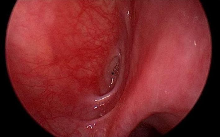 This clinical diagnostic image shows an endoscopic view of the left piriform sinus, located within the hypopharynx. The mucosa is predominantly reddish-pink and demonstrates prominent superficial vascularization. At the apex of the piriform sinus, a distinct, abnormal opening is visible, representing a branchial cleft fistula or sinus tract. The orifice of the fistula appears as a dark, circular indentation with irregular, slightly elevated, and erythematous margins, suggesting localized chronic inflammation or tissue remodeling. The surrounding mucosal texture is uneven, transitioning from smooth areas to more granular surfaces near the pathological opening. This visual finding is characteristic of a congenital branchial anomaly, specifically a third or fourth branchial cleft remnant, which typically presents with recurrent neck infections or abscesses. The image serves as a key educational reference for identifying anatomical landmarks and pathological findings during direct laryngoscopy in Otolaryngology (ENT).