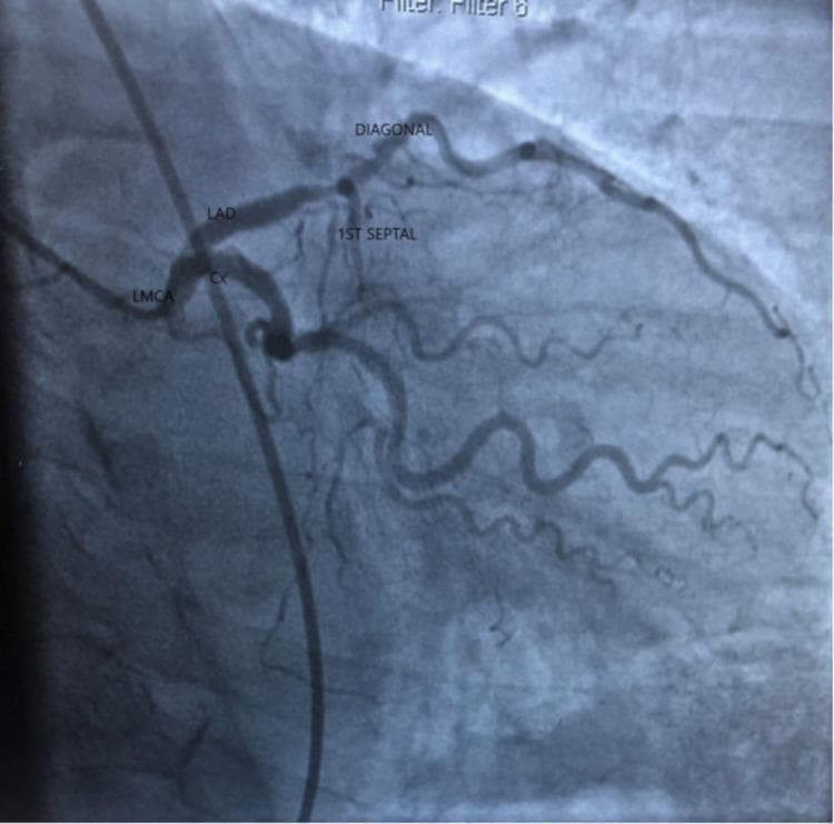 Diagnostic coronary angiogram of the left coronary system. The image shows the Left Main Coronary Artery (LMCA) bifurcating into the Left Anterior Descending (LAD) artery and the Circumflex (Cx) artery. The LAD is visualized proximally, giving off the first septal branch. Distal to the septal branch, a prominent diagonal branch is visible, exhibiting a critical high-grade stenosis (approximately 90%). The circumflex artery demonstrates significant obstructive disease with an estimated 80-90% stenosis in its mid-segment. The diagonal branch appears moderately tortuous compared to the main vessels. This image serves as a clinical demonstration of multi-vessel coronary artery disease (CAD), specifically involving major branches of the left coronary system. Key anatomical landmarks including the LMCA, LAD, Cx, and branching septal/diagonal vessels are labeled to illustrate arterial anatomy and the localization of atherosclerotic lesions for diagnostic and interventional planning.