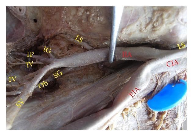 Anatomical dissection of the right hemipelvis demonstrating the arterial supply and branching patterns of the internal iliac artery (IIA). The image shows the common iliac artery (CIA) bifurcating into the external iliac artery (EIA) and the internal iliac artery. This specific specimen exhibits a high variation in IIA length, categorized as a long internal iliac artery. Key vascular branches are labeled, including the superior gluteal artery (SG) originating proximally, and a distal bifurcation forming the inferior gluteal (IG) and internal pudendal (IP) arteries. The anterior division branches, specifically the superior vesical (SV) and inferior vesical (IV) arteries, are visible coursing toward the pelvic viscera. Associated neural and vascular structures such as the lumbosacral trunk (LS) and obturator artery (Ob) are shown in their characteristic anatomical positions relative to the IIA. This clinical photograph is used in medical education to illustrate pelvic surgical anatomy and common vascular variations critical for procedures like arterial ligation or pelvic lymphadenectomy.