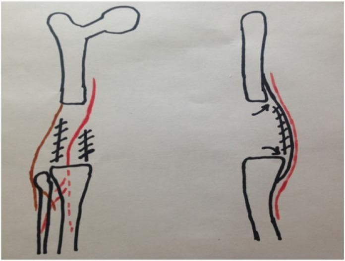 This medical illustration consists of two comparative anatomical diagrams in a posterior view, likely representing surgical concepts related to posterior tissue releases in orthopedic surgery. The left diagram depicts the distal femur, proximal tibia, and fibula forming the knee joint. It features black hatch marks across the posterior joint capsule and soft tissues, alongside red dashed lines indicating ligamentous or neurovascular structures. The right diagram illustrates the effect of a posterior release; it shows a bowed posterior capsule with arrows indicating the mobilization and displacement of tissues away from the joint space. A continuous red line on both diagrams represents the neurovascular bundle or skin contour, demonstrating its relationship to the underlying musculoskeletal structures. This illustration is an educational tool for understanding surgical approaches to correcting knee flexion contractures or managing posterior knee anatomy during joint reconstruction.