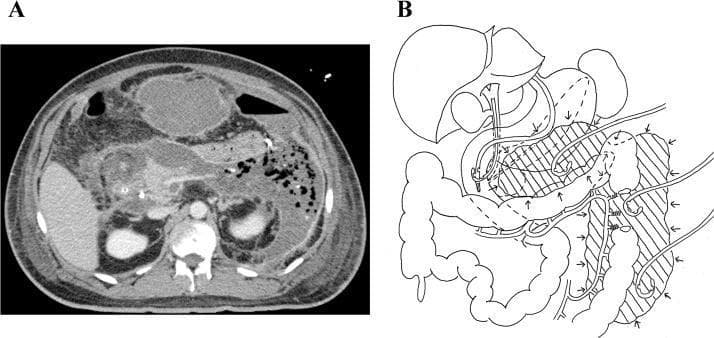 This composite educational graphic details the diagnosis and management of a complex retroperitoneal abscess. Panel A is an axial contrast-enhanced CT scan of the abdomen demonstrating a large, heterogeneous, low-attenuation collection in the retroperitoneal space. The collection is predominantly located in the left hemi-abdomen, involving the peripancreatic region and extending laterally toward the splenic flexure and descending colon. Notable features include internal debris and gas bubbles (mottled air sign), highly suggestive of an infected necrotic process or abscess secondary to severe pancreatitis. Panel B is a corresponding anatomical line diagram illustrating the ultrasound-guided drainage strategy. It depicts three percutaneous pigtail catheters placed to target distinct fluid compartments: the pre-pancreatic space, the area around the splenic flexure, and the paracolic gutter along the descending colon. The diagram clarifies the spatial relationship between the abscess (represented by hatched shading) and the major abdominal organs, including the stomach, liver, pancreas, and colon, highlighting the multidisciplinary approach to managing deep-seated abdominal sepsis.