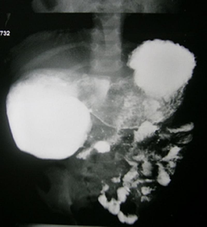 This diagnostic image is an abdominal X-ray from an upper gastrointestinal (UGI) contrast study, likely in a pediatric patient given the skeletal development. The radiograph demonstrates a 'double bubble' sign characterized by two large, well-defined, radiopaque collections of contrast material in the upper abdomen. The proximal bubble corresponds to a dilated stomach, and the second, more right-sided bubble represents a dilated proximal duodenum. Distal to these structures, there is a sparse, mottled, and fragmented distribution of contrast material within the lower intestinal loops. This pattern suggests a partial or high-grade intestinal obstruction, consistent with a fenestrated duodenal membrane or web in the second part of the duodenum. The presence of some contrast distal to the primary dilatation indicates the obstruction is not complete, distinguishing it from total duodenal atresia. Educational value lies in the radiological identification of neonatal/pediatric intestinal obstruction and the interpretation of contrast transit in congenital duodenal anomalies.