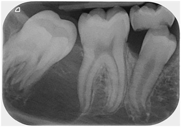 A long-cone periapical radiograph of the mandibular right molar region (LR6/LR7) showing a prominent intraosseous lesion. The image reveals a well-defined, unilocular, and uniformly radiolucent lesion measuring approximately 5 × 10 mm. It is situated between the distal root of the fully erupted permanent first molar and the crown of the unerupted permanent second molar. The lesion extends from the distal cervical area of the first molar toward the apical region of the second molar. The second molar appears mesially tilted and displaced inferiorly by the radiolucency. The adjacent first molar roots show clear morphology without signs of resorption. The cortical borders of the lesion are distinct, suggesting a slow-growing cystic or neoplastic process such as an odontogenic keratocyst (OKC) or dentigerous cyst. This diagnostic image is intended for dental students and clinicians to illustrate the radiographic presentation of unilocular odontogenic lesions and their spatial relationship to developing dentition.