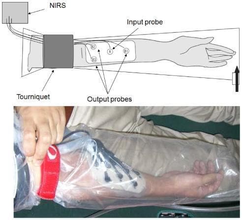 This composite educational resource consists of a labeled anatomical diagram (top) and a corresponding clinical photograph (bottom) illustrating a novel transcutaneous carbon dioxide (CO2) application system for physiological research. The system is applied to the human forearm to study O2 dissociation from hemoglobin using Near-Infrared Spectroscopy (NIRS). Key components include a proximal tourniquet for inducing local ischemia, a NIRS probe assembly with one central input probe (labeled A) and three surrounding output probes (B1, B2, B3) placed over a hydrogel patch on the dorsal forearm, and a transparent, airtight CO2 adaptor encasing the entire limb from distal arm to hand. The clinical photograph demonstrates the real-world application of these components, showing the hydrogel interface on the skin and the sealed plastic chamber used to maintain high CO2 concentrations. This setup is designed to evaluate how transcutaneous CO2 absorption affects local tissue oxygenation and hemodynamics, relevant for research in sports medicine, rehabilitation, and vascular physiology.