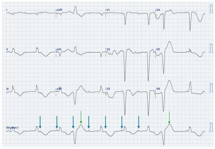 This diagnostic image is a 12-lead electrocardiogram (ECG) demonstrating a complex cardiac arrhythmia in a 71-year-old male. The tracing shows complete atrioventricular (AV) dissociation, a hallmark of third-degree heart block. A sinus rhythm (atrial rate approximately 60 bpm) is present, indicated by P-waves that bear no constant relationship to the QRS complexes. A junctional escape rhythm (ventricular rate approximately 45 bpm) is noted, marked by blue arrows in the rhythm strip. The QRS morphology indicates a nonspecific interventricular conduction delay. Additionally, the ECG captures frequent ventricular ectopy; green arrows highlight premature ventricular complexes (PVCs) occurring with an 'R-on-T' phenomenon, where the ectopic beat falls very close to the preceding T-wave. This pattern is clinically significant as a precursor to malignant ventricular arrhythmias such as Torsades de Pointes. The baseline undulations and varying morphologies of the ectopic beats further suggest electrical instability. This ECG is essential for teaching advanced cardiovascular life support (ACLS) concepts, specifically the recognition and management of complete heart block and high-risk ventricular ectopy.