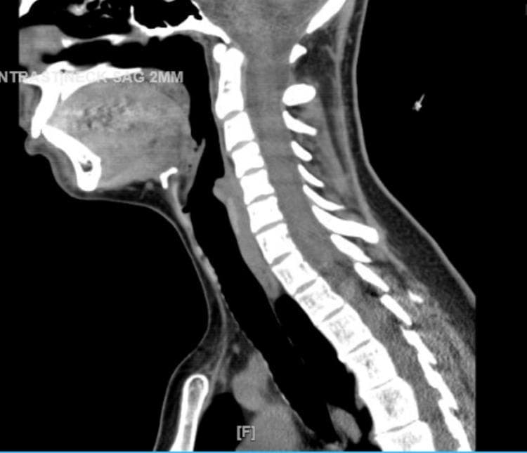This diagnostic image is a non-contrast Computed Tomography (CT) scan of the neck in a sagittal view. The image illustrates the upper respiratory and digestive tract anatomy, specifically focusing on the soft tissues of the pharynx and larynx. Following resolution of a previous obstruction, this scan demonstrates a patent airway with visible restoration of the air column in the hypopharynx and laryngeal regions. Key anatomical landmarks include the cervical vertebrae (C1-C7), the base of the tongue, the epiglottis, and the hyoid bone. The soft tissues surrounding the airway show normal thickness and density, indicating a significant reduction in the edema previously noted in the clinical history. The image serves as a comparison to illustrate the resolution of drug-induced angioedema or inflammatory swelling that had compromised the airway at the level of the hyoid cartilage. It is a critical teaching tool for understanding airway patency and the radiological monitoring of soft tissue emergencies in otolaryngology and emergency medicine.