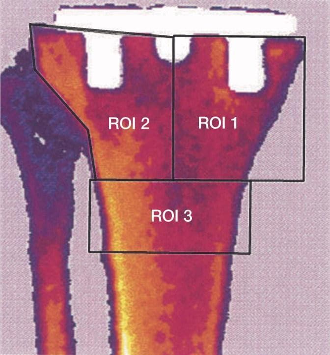 A pseudocolor Dual-Energy X-ray Absorptiometry (DEXA) scan of a proximal tibia in the anterior-posterior (AP) projection, demonstrating a periprosthetic bone mineral density (BMD) analysis after total knee arthroplasty. The image features three distinct Regions of Interest (ROIs) used to quantify bone remodeling around a tibial prosthesis. ROI 1 (medial) and ROI 2 (lateral) are 4 cm long rectangular boxes positioned immediately distal to the tibial component tray, spanning from the central axis to the respective cortical margins. ROI 3 is a 2 cm long rectangular area located immediately distal to ROI 1 and 2, spanning the full width of the tibial shaft. The color scale indicates BMD levels: yellow and orange represent higher bone density, while red and purple signify lower density. This visualization is used in orthopedic research to monitor stress shielding, bone resorption, or osseointegration adjacent to orthopedic implants over time.