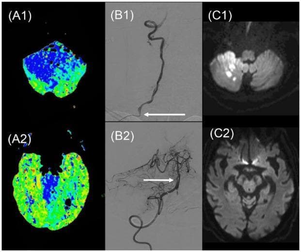Multi-modal neuroimaging composite illustrating a case of acute basilar artery occlusion (BAO) and subsequent endovascular treatment. (A1, A2) Color-coded CT Perfusion (CTP) maps showing Mean Transit Time (MTT) at the medullary and midbrain levels; the predominant blue areas signify extensive hypoperfusion in the posterior circulation territory. (B1) Conventional digital subtraction angiography (DSA) of the vertebral artery reveals high-grade stenosis at the vertebral origin (arrow) and complete basilar artery occlusion. (B2) Post-thrombectomy DSA demonstrates successful recanalization of the basilar artery, though a non-stenosing mid-basilar dissection is visible (arrow). (C1, C2) Follow-up sub-acute Diffusion-Weighted Imaging (DWI) MRI axial slices showing hyperintense areas in the right cerebellum indicating a limited infarct volume, with relative sparing of the brainstem at the midbrain level. This sequence highlights the clinical correlation between perfusion deficits, arterial occlusion/stenosis, and final infarct core in posterior circulation stroke management.