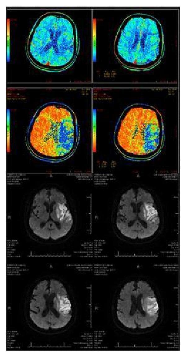 A multi-panel neuroimaging collage illustrating the radiographic assessment of acute ischemic stroke and penumbral mismatch. The top four panels display axial CT Perfusion (CTP) color maps. The uppermost row shows relatively uniform blue hues representing preserved Cerebral Blood Volume (CBV), while the second row exhibits large areas of orange and red signal in the left hemisphere, indicating prolonged Mean Transit Time (MTT) or reduced Cerebral Blood Flow (CBF). This perfusion-diffusion mismatch identifies the 'tissue at risk' or ischemic penumbra. The bottom four panels present axial Diffusion-Weighted Imaging (DWI) MRI sequences taken 24 hours post-intervention. These images show a localized region of hyperintensity (bright signal) in the left frontoparietal and subcortical regions, representing the final infarct core or completed stroke. Comparing the large area of perfusion abnormality on CTP to the smaller restricted diffusion area on MRI allows for the calculation of percentage area salvage, a key metric in evaluating the efficacy of mechanical thrombectomy.