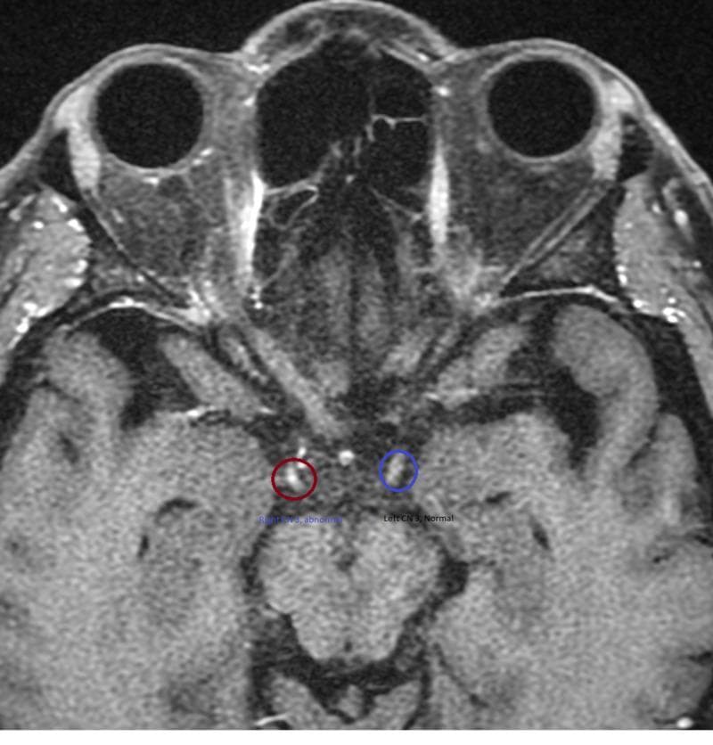 This diagnostic image is an axial T1-weighted post-contrast magnetic resonance imaging (MRI) of the head at the level of the midbrain and interpeduncular cistern. The primary focus is the comparison of the bilateral third cranial nerves (oculomotor nerve, CN III). The right CN III, highlighted by a red circle, exhibits focal abnormal enhancement, appearing as a hyperintense (bright) signal compared to the surrounding anatomy. In contrast, the left CN III, highlighted by a blue circle, shows normal signal intensity without evidence of enhancement. Other visible anatomical structures include the orbits and globes, the optic nerves and chiasm, and the brain parenchyma of the temporal lobes. The clinical significance of this finding is indicative of inflammation, demyelination, or compression of the oculomotor nerve, often associated with conditions such as Miller Fisher syndrome or ophthalmoplegic migraine. This comparison serves as a diagnostic educational tool for identifying abnormal nerve enhancement in neuroimaging.