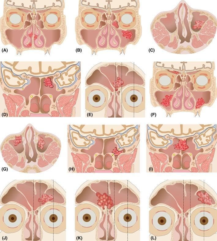 A multi-panel schematic anatomical diagram illustrating an endoscopic staging system for sinonasal inverted papilloma (SNIP). The visual set (A–L) categorizes stages 1 through 4 based on primary tumor origin sites within the paranasal sinuses and nasal cavity. Stage 1 (A) shows isolated nasal cavity involvement. Stage 2 (B–E) demonstrates tumors originating in the ethmoid sinus, superior/lateral/posterior maxillary walls, medial sphenoid sinus, or frontal sinus between the midline and lamina papyracea. Stage 3 (F–K) illustrates involvement of the anterior/medial maxillary walls, lateral sphenoid recess, bilateral sphenoid sinus, or frontal sinus regions extending from the lamina papyracea to the central pupil line. Stage 4 (L) depicts tumor origin lateral to the central pupil in the frontal sinus. Anatomical landmarks highlighted include the facial midline, lamina papyracea, and central pupil for surgical accessibility mapping. This diagnostic illustration serves as a clinical guide for otolaryngologists to determine endoscopic versus external surgical approaches based on the degree of anatomical difficulty and recurrence risk associated with specific tumor origin sites.