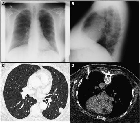 This composite diagnostic image illustrates the identification and interventional management of a solitary pulmonary nodule, identified as a lung metastasis. Panel A (frontal) and Panel B (lateral) are chest X-rays demonstrating a well-defined, rounded soft tissue opacity—often termed a 'coin lesion'—located in the mid-zone of the left lung. Panel C provides a corresponding high-resolution axial CT scan in lung-window setting, confirming a solitary, hyperdense, peripheral mass with distinct margins in the posterior segment of the left lung. Panel D shows an axial CT image of the patient in the prone position during a CT-guided percutaneous needle biopsy. A biopsy needle is clearly visible traversing the posterior chest wall and terminating within the target lesion. This educational series demonstrates the clinical pathway from radiological detection via X-ray to diagnostic characterization using CT and definitive tissue sampling. The case highlights staging protocols for metastatic disease, particularly relevant in oncology for determining disease progression and treatment planning.