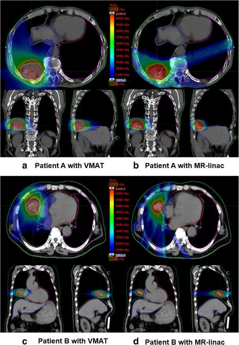 This diagnostic image displays a comparison of radiation therapy dose distributions between Volumetric Modulated Arc Therapy (VMAT) and MRI-based Intensity Modulated Radiation Therapy (IMRT) for two representative patients (A and B). The content consists of thoracic CT scans in axial, coronal, and sagittal planes, overlaid with color-coded radiation dose heatmaps ranging from 1200 cGy (blue) to over 6300 cGy (red/orange). For Patient A (a and b), the VMAT plan shows a broader low-dose wash extending into surrounding tissues, while the MRI-based IMRT using an MR-linac demonstrates a more concentrated high-dose region and a steeper dose gradient. For Patient B (c and d), the high-dose distribution is evaluated in relation to organs at risk, including the heart and lungs. The MRI-based IMRT illustrates tighter conformity to the Planning Target Volume (PTV) but reveals specific beam entry pathways through the contralateral lung or near the spinal cord, whereas VMAT displays the typical 'arc' distribution pattern with more diffuse low-dose spread across the anatomical structures.