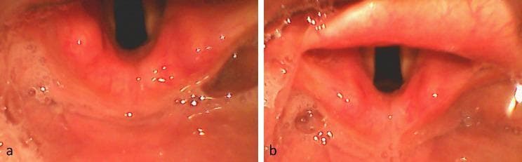 Comparison of glottic visualization during videolaryngoscopic intubation using two different techniques. Panel (a) demonstrates indirect epiglottis elevation, where the laryngoscope blade tip is typically placed in the vallecula. This view shows a partially obscured glottis with the epiglottis remaining in a relatively neutral position, limiting the direct line of sight to the vocal cords. Panel (b) illustrates direct epiglottis elevation, achieved by placing the blade tip directly under the epiglottis to lift it. This technique results in a more comprehensive glottic exposure, revealing the vocal cords, arytenoid cartilages, and a clearer glottic opening (rima glottidis). Both images show the normal anatomy of the upper airway, including the reddish-pink laryngeal mucosa and the posterior pharyngeal wall. The comparison highlights the differences in anatomical exposure relevant to airway management and tracheal tube placement, often quantified by the Percentage of Glottic Opening (POGO) score.