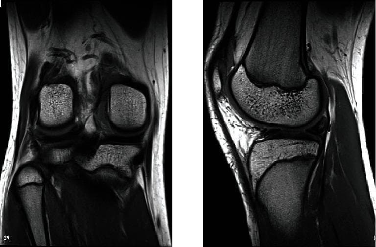 This diagnostic image displays two views (coronal and sagittal) of the knee joint via proton density-weighted Magnetic Resonance Imaging (MRI). The imaging reveals the distal femur, proximal tibia, and fibular head, alongside the patellofemoral compartment. A focal area of increased signal intensity is visible within the posterior segment of the lateral meniscus, accompanied by an apparent increase in meniscal volume and thickness compared to normal morphology. The sagittal view demonstrates the relationship between the femoral condyle and the tibial plateau, highlighting the thickened meniscus in the lateral compartment. These findings are clinically significant as they suggest structural anomalies such as a discoid lateral meniscus or a double-layered lateral meniscus, providing key diagnostic evidence for patients presenting with mechanical knee symptoms like locking or joint line tenderness.