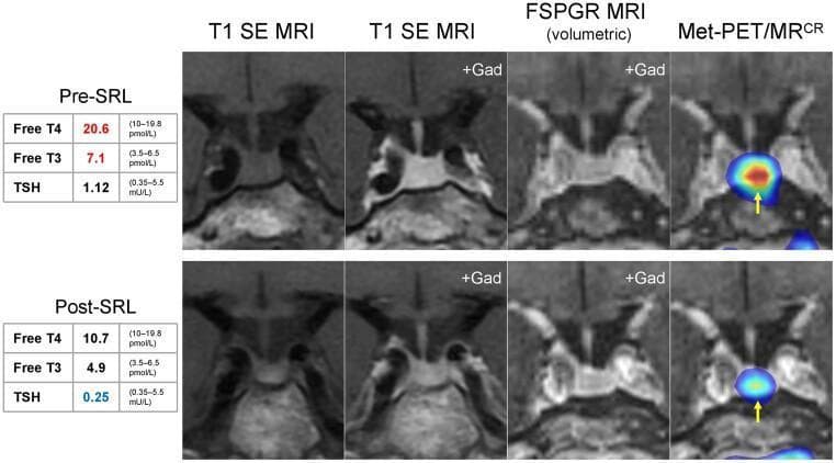 A comparison panel of diagnostic images illustrating molecular and anatomical pituitary imaging in a patient with a TSH-secreting microadenoma (thyrotropinoma). The content displays two rows representing 'Pre-SRL' (somatostatin receptor ligand) and 'Post-SRL' treatment states, featuring coronal T1 spin-echo (SE) MRI, T1 SE with Gadolinium, volumetric fast spoiled gradient recalled echo (FSPGR) MRI, and 11C-methionine PET coregistered with FSPGR MRI (Met-PET/MRCR). While anatomical MRI sequences (T1, +Gad, FSPGR) appear unremarkable and show no structural changes between treatment states, the functional Met-PET/MRCR reveals a distinct, focal radiotracer uptake (intense red/yellow signal) just to the left of the infundibulum insertion. Following SRL therapy, there is a dramatic diminution in radiotracer intensity (shifting to blue), correlating with normalized thyroid function tests (Free T4, Free T3, and TSH values shown in adjacent tables). This comparison highlights the utility of functional PET imaging in localizing occult microadenomas that are not detectable via standard structural MRI.