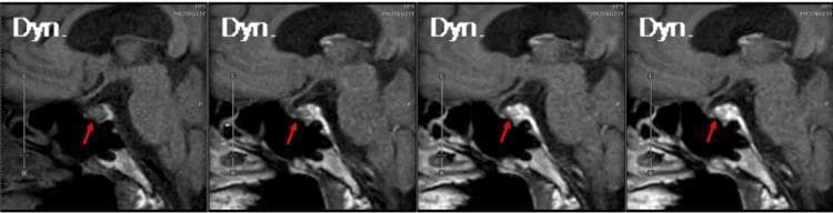 This diagnostic image series consists of four T1-weighted sagittal dynamic contrast-enhanced (DCE) MRI frames of the pituitary gland, progressing from an arterial/early phase (left) to a late venous phase (right). The red arrow indicates the pituitary gland situated within the sella turcica. The sequence demonstrates normal contrast wash-in, where the pituitary stalk and posterior pituitary enhance initially, followed by diffuse, homogeneous enhancement of the adenohypophysis. Visible anatomical landmarks include the sphenoid sinus (inferior), the optic chiasm (superior), and the pons (posterior). The images are used to assess the pituitary for secondary signs of pathology, such as hypophysitis or microadenomas, which may present with delayed or altered enhancement patterns. In this specific case, the pituitary appears normal in size and morphology with appropriate contrast kinetics, providing radiographic evidence against structural causes in patients presenting with hormonal deficiencies like isolated ACTH deficiency.