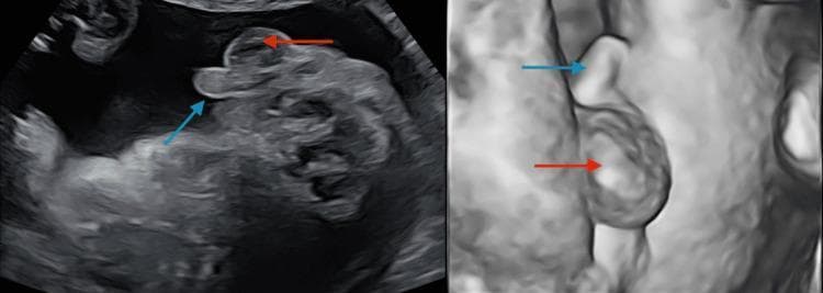 This composite diagnostic image displays a 20-week gestation level 2 ultrasound scan focusing on fetal perineal anatomy. The image is split into two views: a standard 2D grayscale sonogram on the left and a 3D/surface-rendered reconstruction on the right. In both views, the external male genitalia are clearly visualized and annotated with colored arrows. A blue arrow identifies the penis, which appears as an elongated, echogenic projection. A red arrow identifies the scrotum, seen as a rounded, more inferiorly positioned structure. The 3D view provides enhanced spatial perspective and surface topography of the genital phenotype. This imaging is used during routine second-trimester anatomy scans for sex determination and to screen for genital anomalies. In this clinical context, the visualization of a clear male phenotype is used to confirm fetal sex, particularly when investigating discrepancies with non-invasive prenatal testing (NIPT).