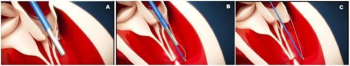 A three-panel anatomical diagram (A-C) illustrating the step-by-step surgical implantation of artificial chordae using the CardioMech system for mitral valve repair. (A) Shows a transcatheter delivery system (blue catheter with a silver metallic distal tip) approaching the posterior mitral leaflet (PML) to perform a puncture. (B) Illustrates the deployment and anchoring of a blue ePTFE artificial chord into the papillary muscle within the left ventricle. (C) Depicts the final stage where the neochorda is tensioned to adjust the leaflet's position and ensure proper coaptation. The diagram highlights the interaction between the surgical instruments, the thin blue artificial chordae, and the cardiac anatomy, including the mitral leaflets and papillary muscles. This educational visual is designed to demonstrate minimally invasive, beating-heart techniques for correcting mitral regurgitation by replacing ruptured or elongated natural chordae tendineae.