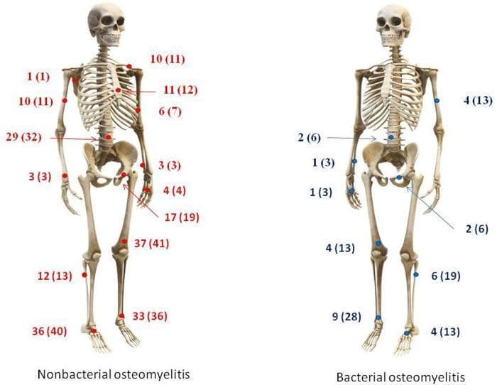 This Comparison Chart consists of two side-by-side anatomical diagrams of the human skeleton, illustrating the distribution and frequency of skeletal foci in nonbacterial osteomyelitis (NBO, left) and bacterial osteomyelitis (BO, right). Each diagram uses colored markers and numerical labels (n values and percentages) to indicate affected anatomical regions. The NBO diagram (red markers) demonstrates a multifocal, widespread distribution across both the axial and appendicular skeleton, with significant involvement of the clavicle, sternum, ribs, spine, femur, tibia, and foot bones. In contrast, the BO diagram (blue markers) displays a more localized or paucifocal pattern, primarily involving the spine, femur, tibia, and fibula, with notable absence of involvement in the clavicle and sternum. This visual comparison highlights key diagnostic differences between the two conditions, emphasizing that multifocality and involvement of the axial skeleton (beyond the spine) are highly suggestive of a nonbacterial etiology. The educational focus is on the clinical differentiation of pediatric bone infections and inflammatory disorders through skeletal mapping.