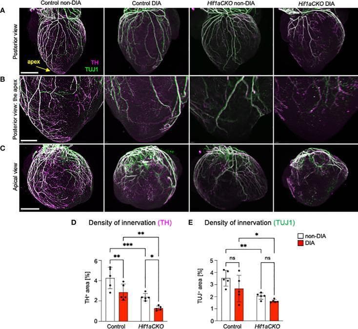 Educational medical visualization detailing cardiac sympathetic innervation in a mouse model at embryonic day E18.5. Panels A, B, and C present immunohistochemical staining images across four experimental groups: Control non-diabetic (non-DIA), Control diabetic (DIA), Hif1a conditional knockout (CKO) non-DIA, and Hif1aCKO DIA. The images utilize double labeling with Tyrosine Hydroxylase (TH, magenta), a sympathetic neuron marker, and Class III β-tubulin (TUJ1, green), a pan-neuronal marker. Row A shows a posterior view of the whole heart, Row B provides a high-magnification detail of the apex, and Row C displays an apical view. The visual evidence shows a dense, branching plexus of nerve fibers in the non-DIA Control, which becomes progressively sparse in the DIA and Hif1aCKO groups. The Hif1aCKO DIA heart exhibits the most severe denervation, with nearly complete loss of apical TH+ fibers. Panels D and E include bar graphs quantifying the density of TH+ and TUJ1+ innervation as a percentage of heart area, with statistical significance indicated by asterisks, demonstrating the synergistic negative impact of Hif1a deficiency and maternal diabetes on autonomic cardiac development.